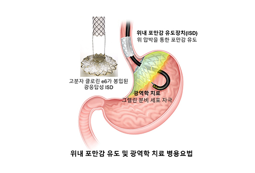 나건 교수 연구팀, 비만 치료 효과 높인  광활성 위내 포만감 유도 장치 개발